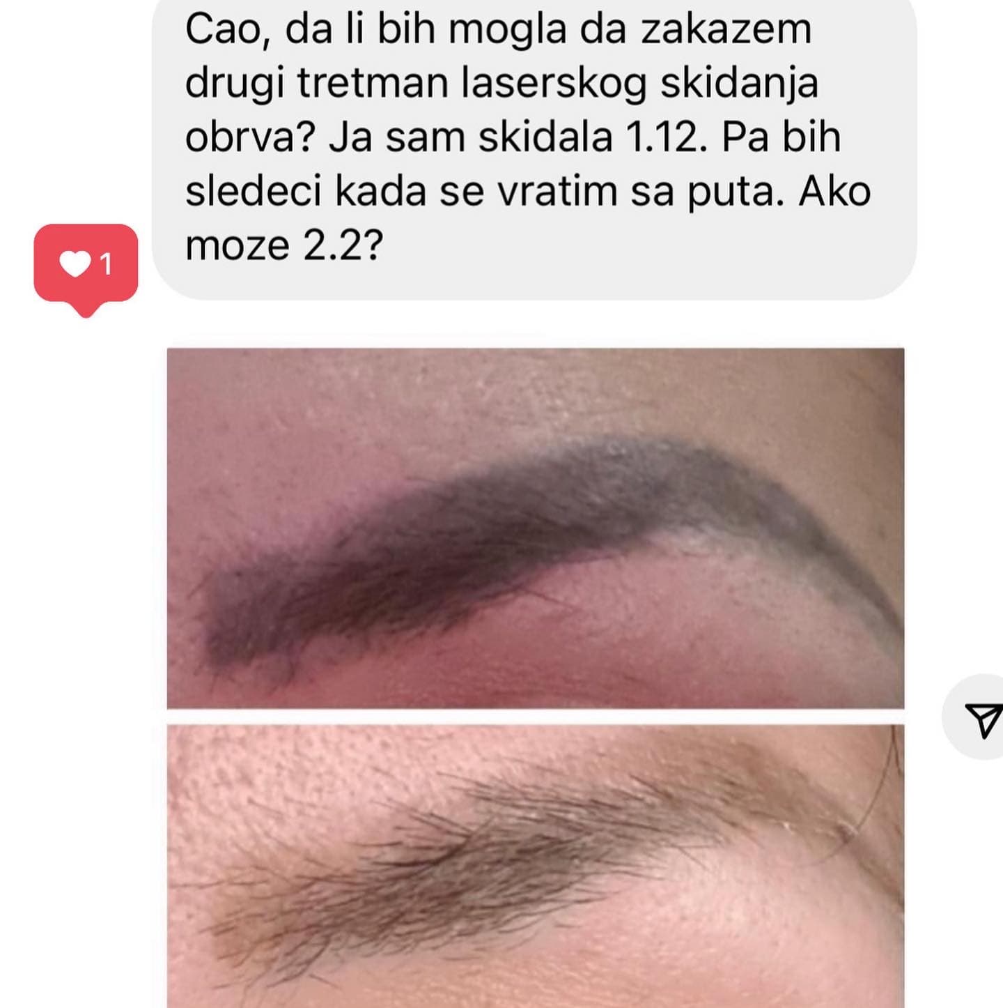 Lasersko skidanje tetovaža i obrva — Studio Revive Beograd