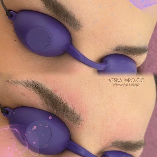 Lasersko skidanje tetovaža — Studio Revive Beograd